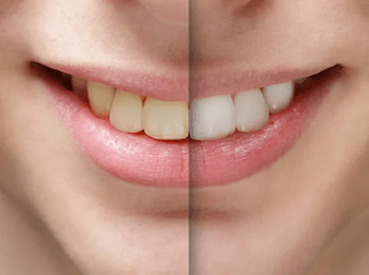 Teeth Whitening